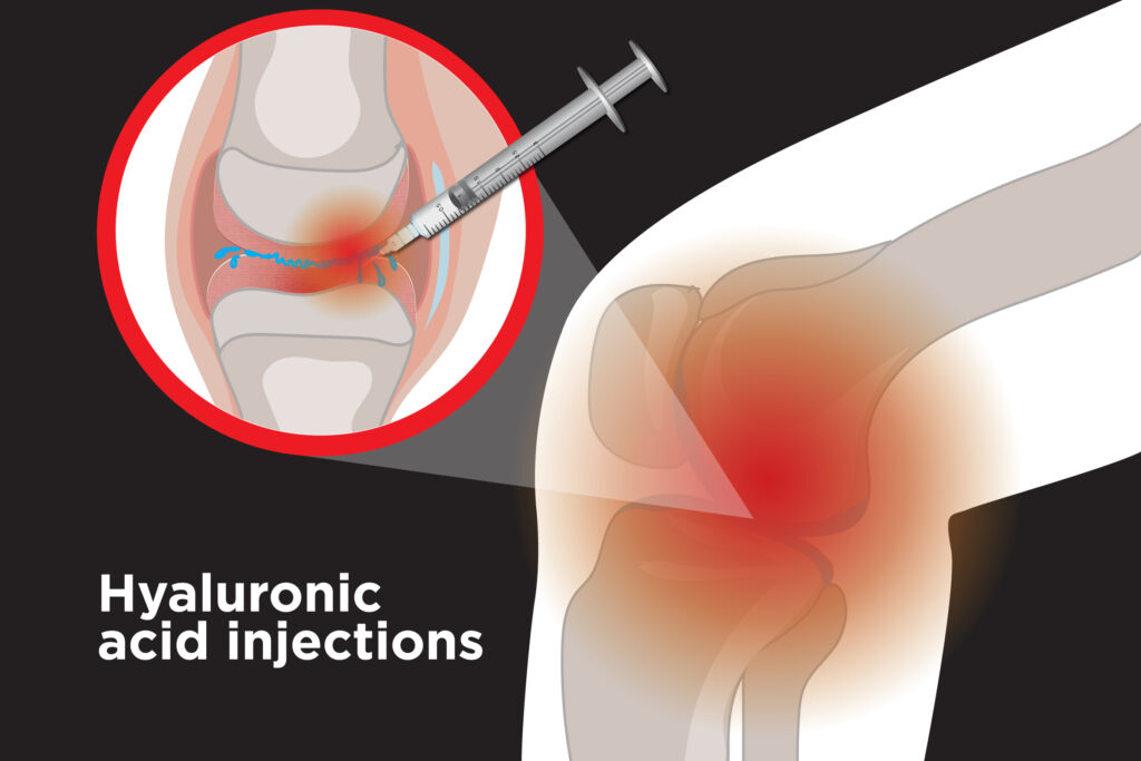hyaluronic acid injections knee