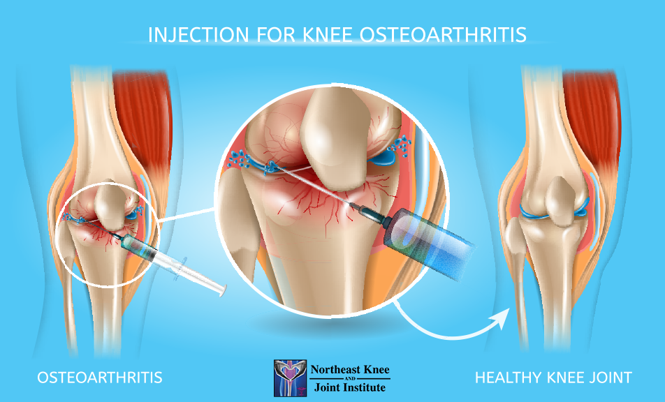 hyaluronic acid injections knee
