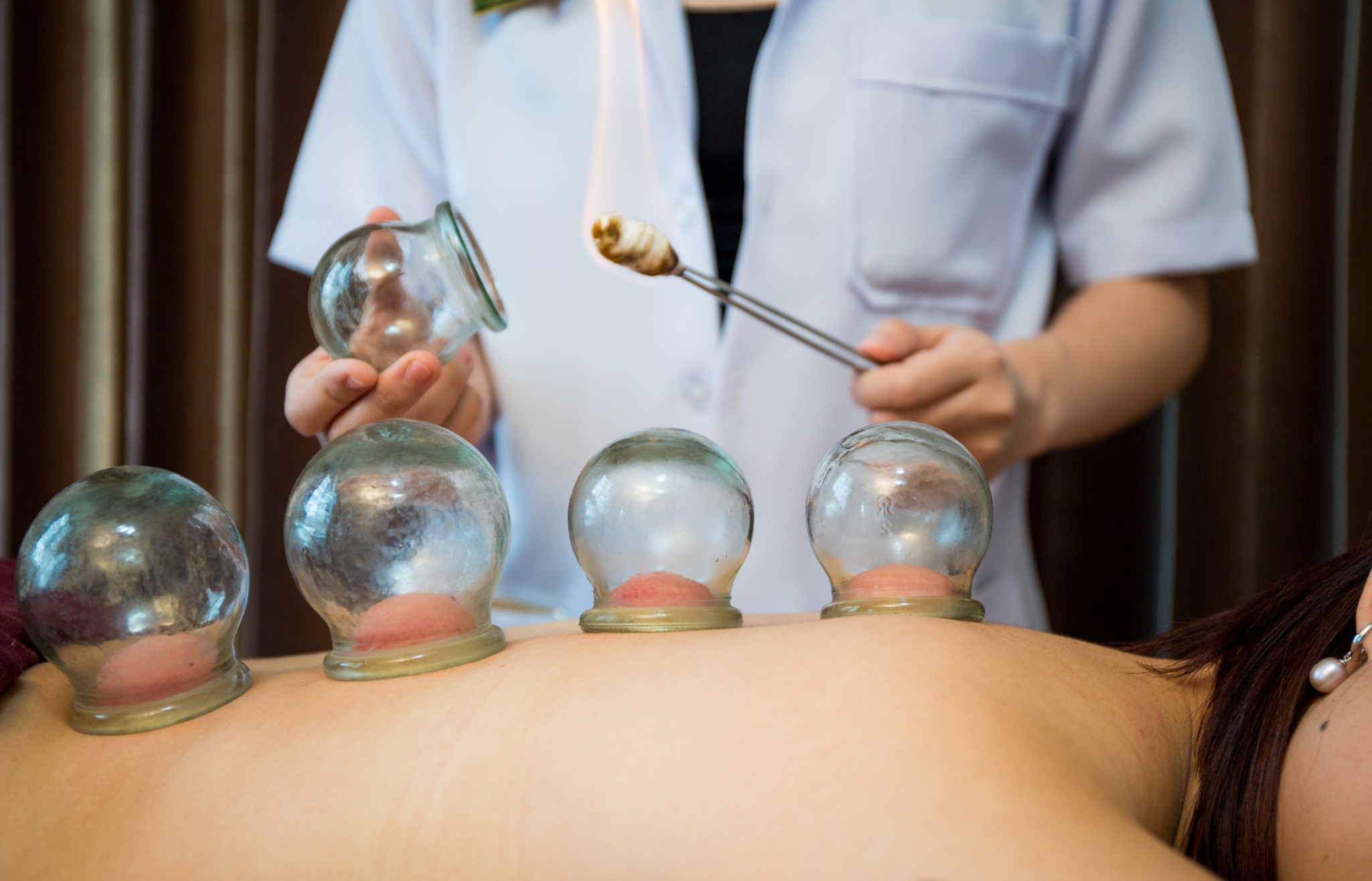 Discover the Benefits of Cupping Therapy Gig Harbor WA