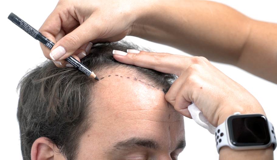 The Ultimate Guide to Hair Transplants in Islamabad: Restoring Confidence and Natural Beauty