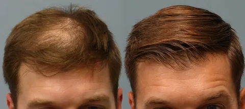 Hair Transplant