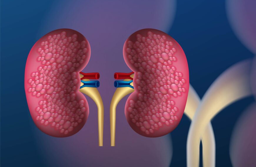 kidney-stone-blog