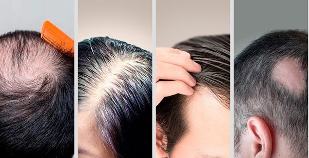 How to strong hair roots for preventing baldness?