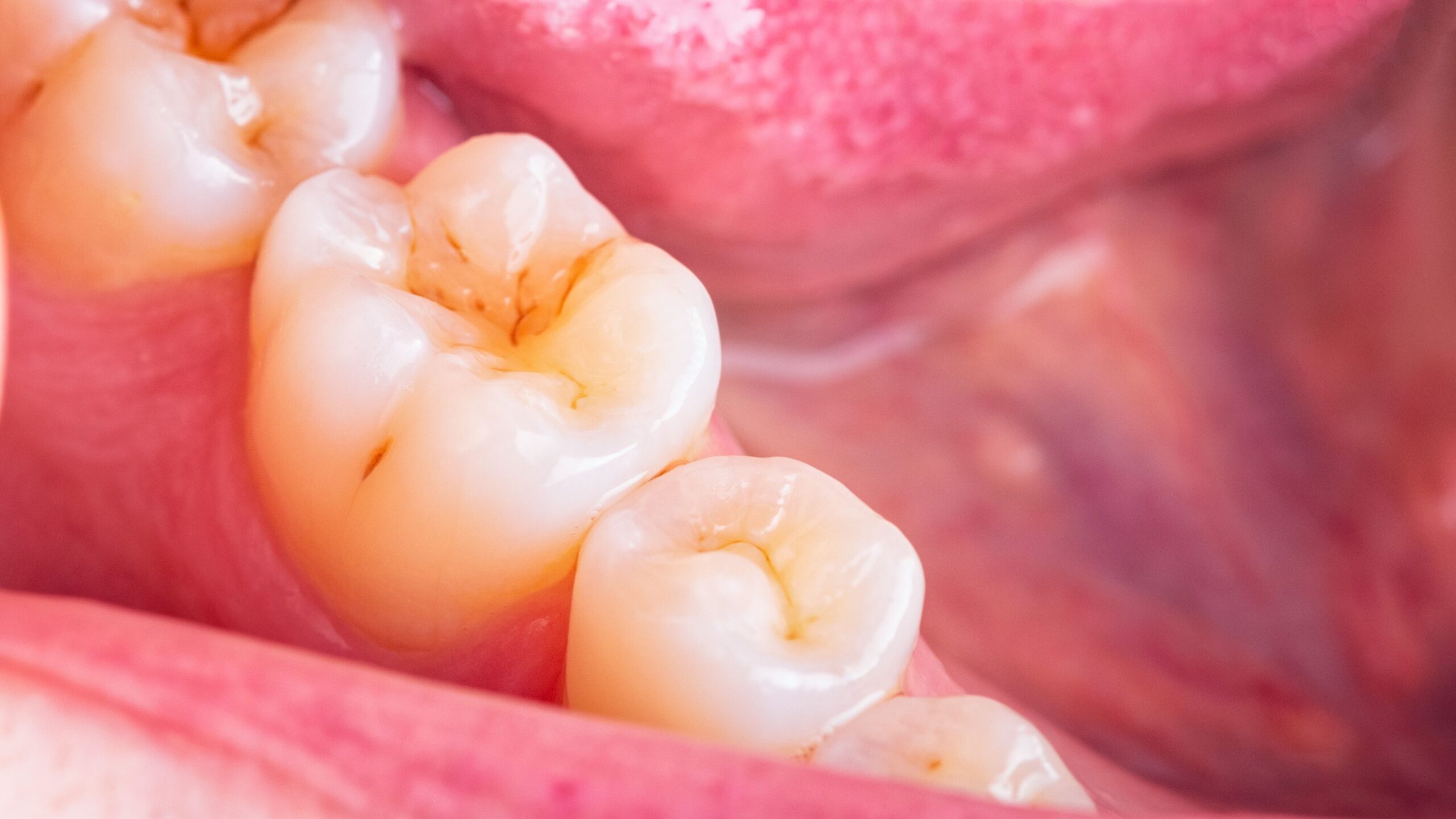Decoding Dental Health: What Do Cavities Look Like? - US iDesk