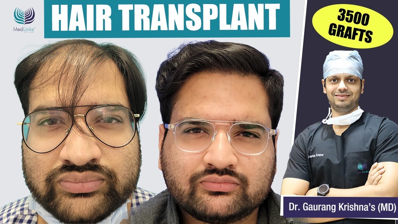 hair transplaant cost in bangalore