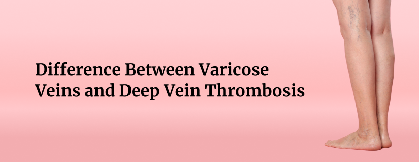 Differences Between Varicose Vein and DVT